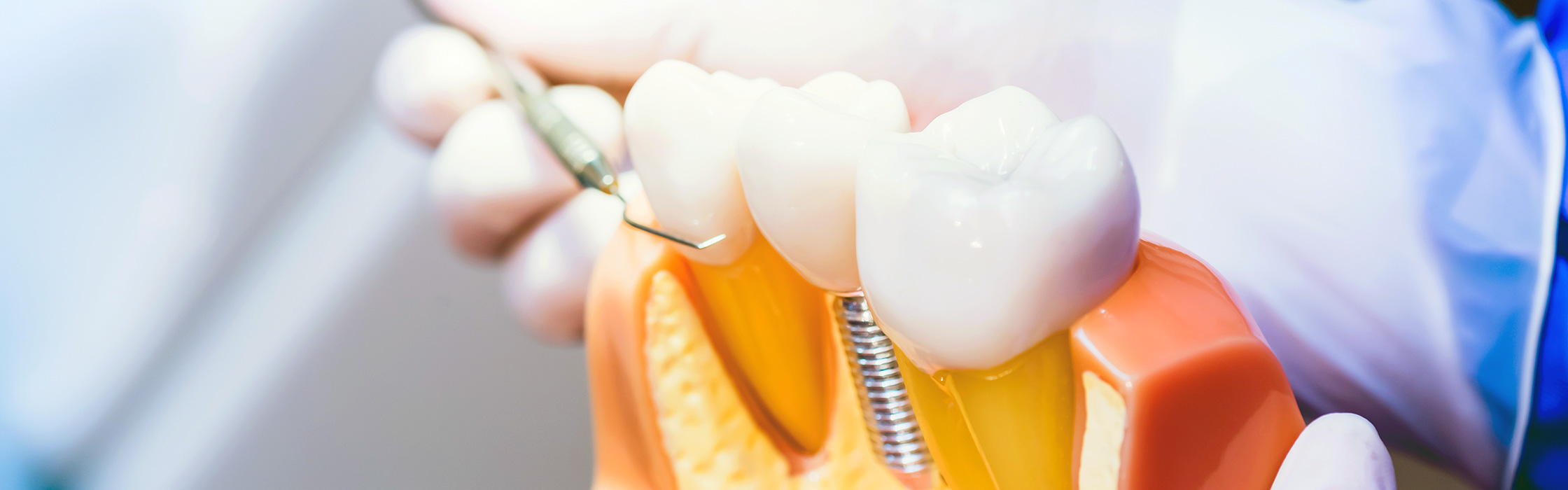 Zahnimplantat: Der professionelle Zahnersatz bei Ihrem Zahnarzt