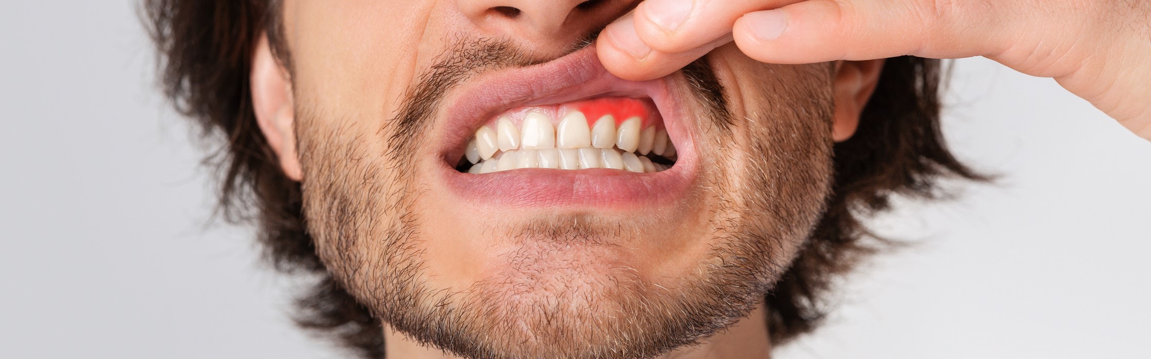 Zahnfleischentzündung – Symptome, Ursachen und alles zur Behandlung bei Ihrem Zahnarzt