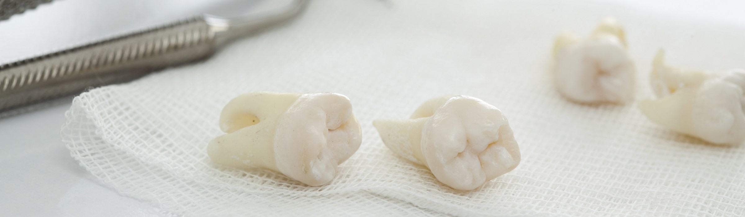 Zahn ziehen – Gründe, Ablauf und Tipps für eine schnelle Wundheilung nach einer Zahnextraktion