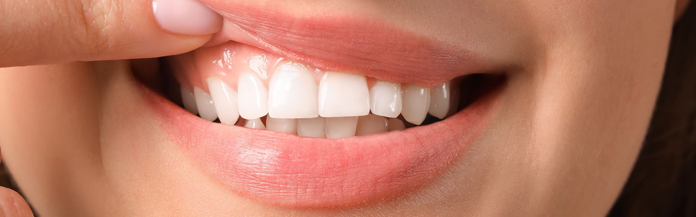 Gummy Smile Korrektur: Endlich wieder unbeschwert lächeln