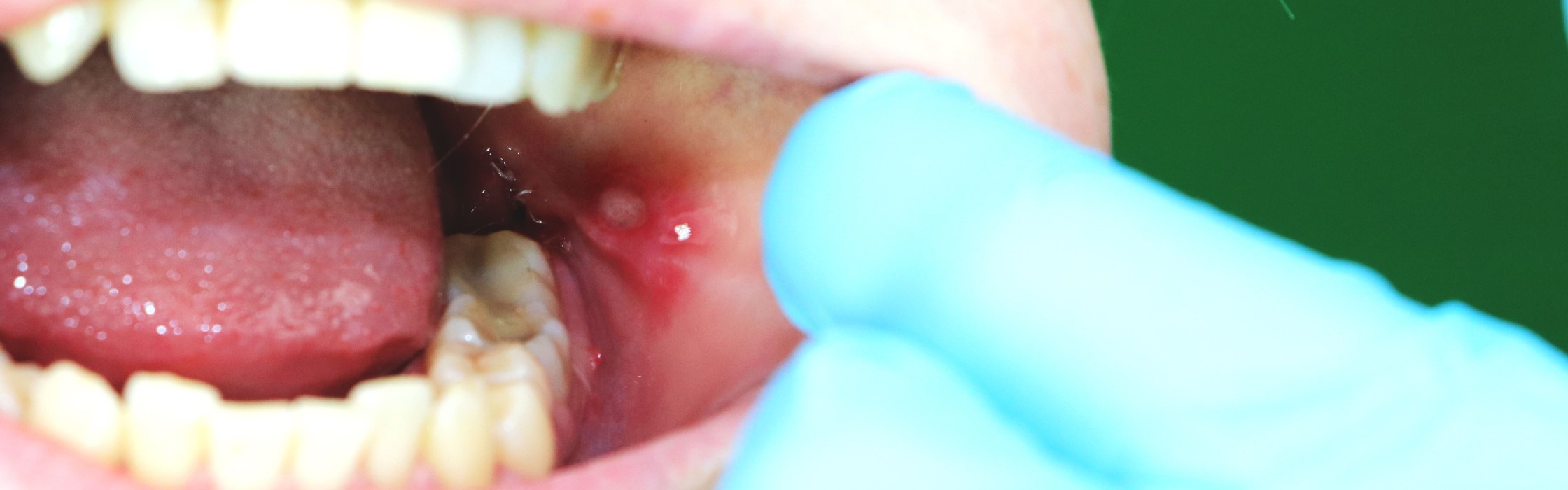 Mundfäule: Wenn Herpes die Mundschleimhaut befällt