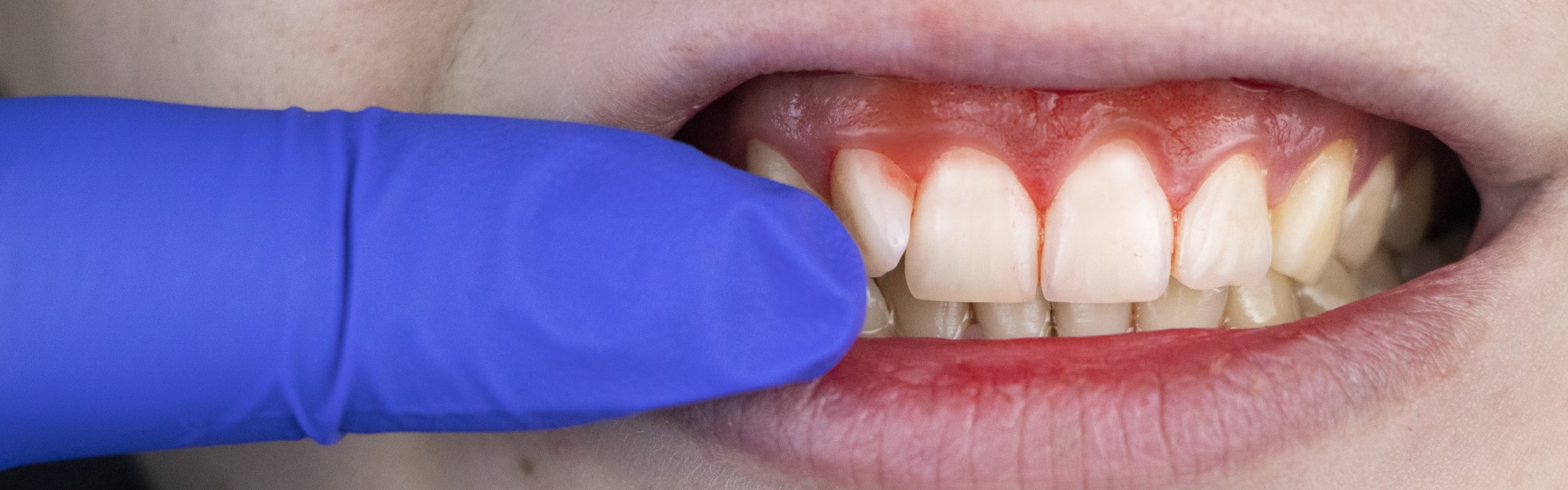 Parodontitis – Prävention und Behandlung der Volkskrankheit bei Ihrem Zahnarzt