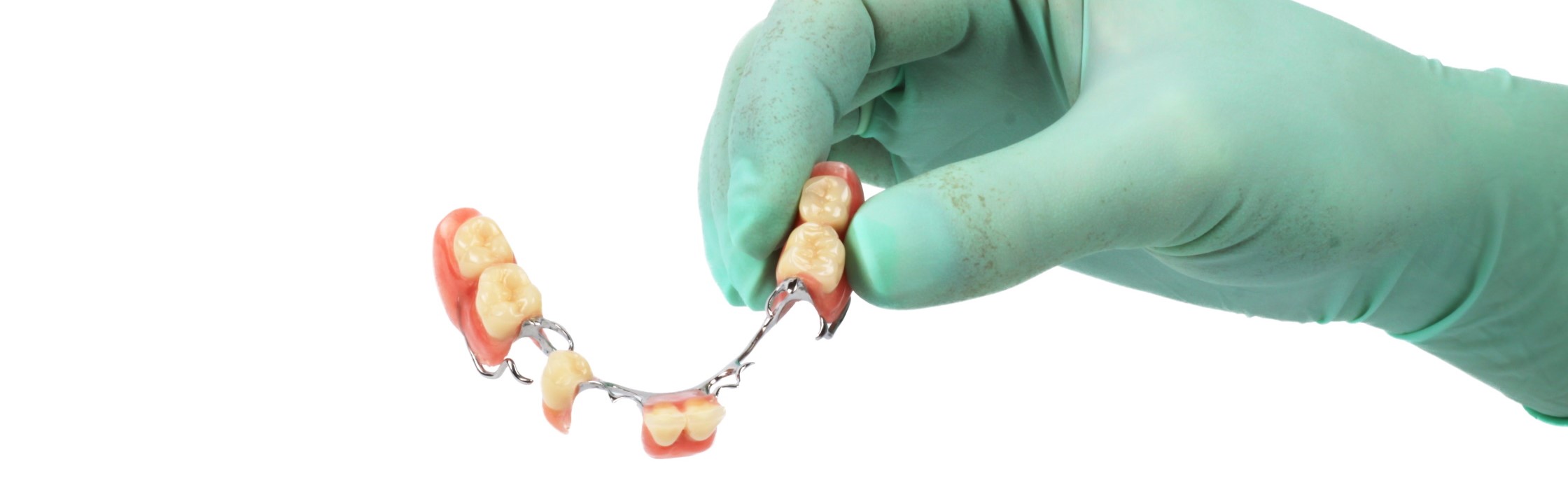 Zahnbrücke: So kann ihr Zahnarzt Zahnlücken ästhetisch schließen