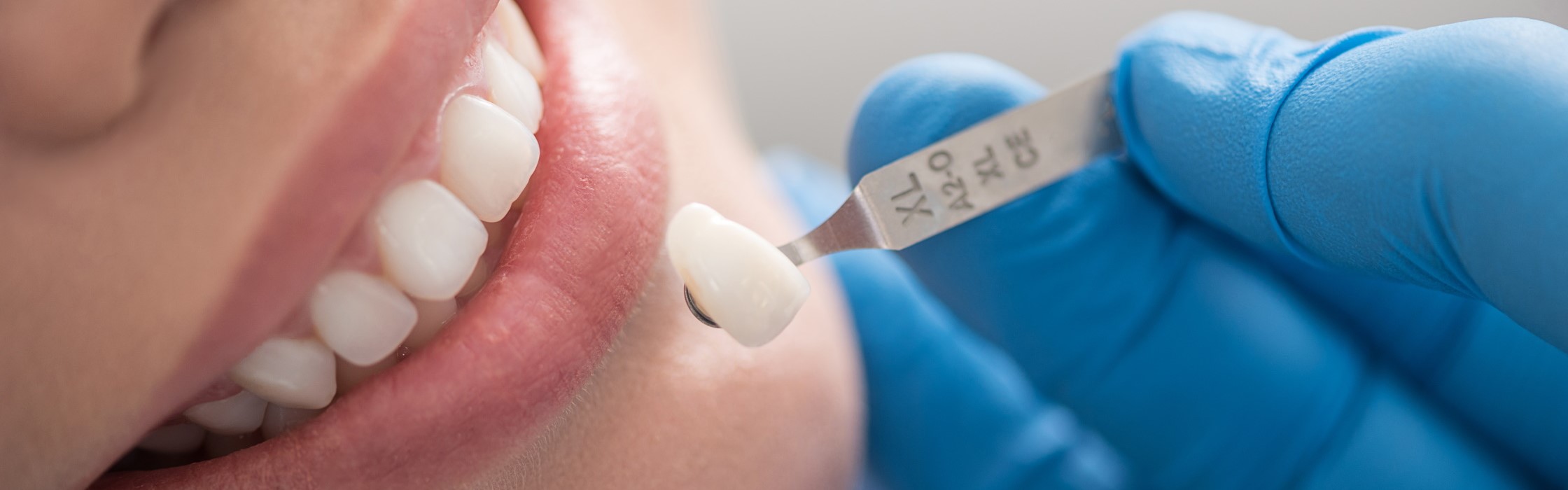 Zahnkronen – Zahnersatz bei Ihrem Zahnarzt