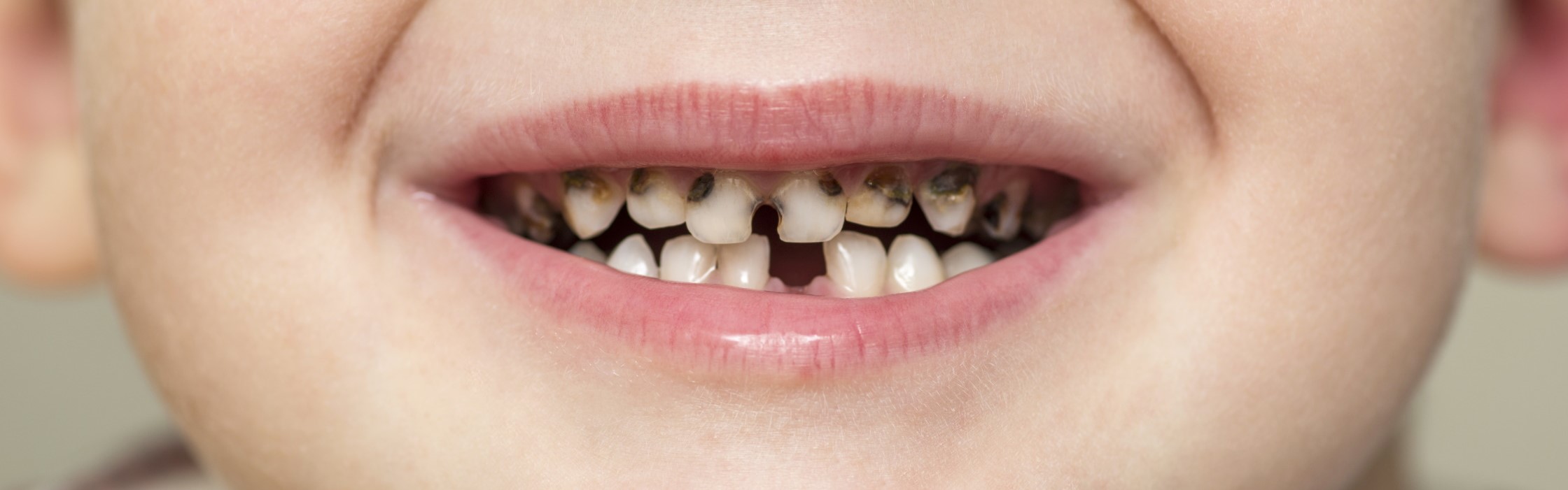 Karies: Welche Ursachen gibt es für die Zahnerkrankung?