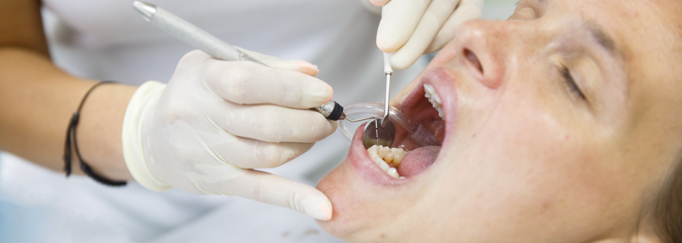 Zahnstein: So entsteht der gehärtete Zahnbelag