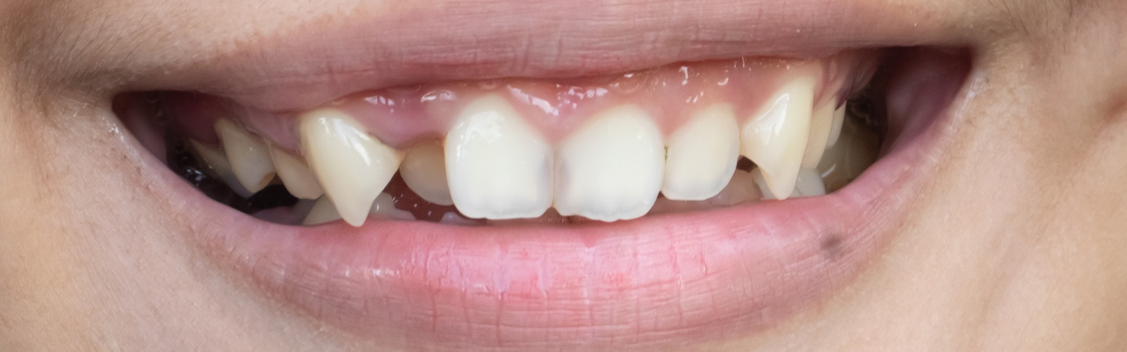 Schiefe Zähne – Ursachen und Behandlung von Fehlstellungen