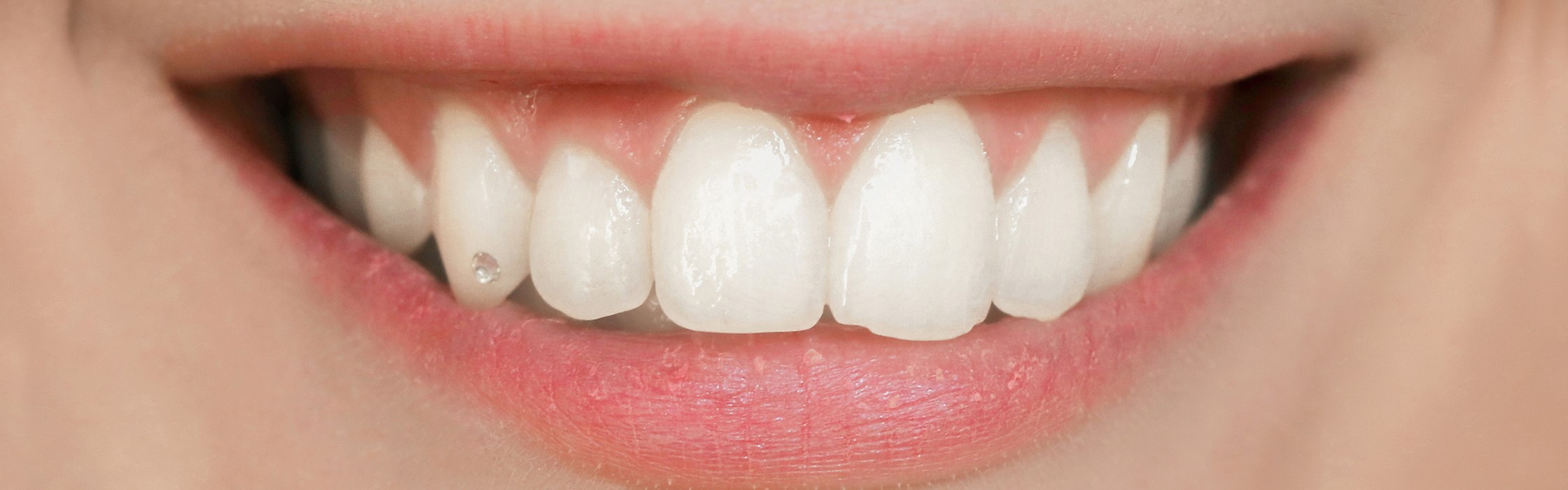 Zahnschmuck – Accessoires für ein funkelndes Lächeln