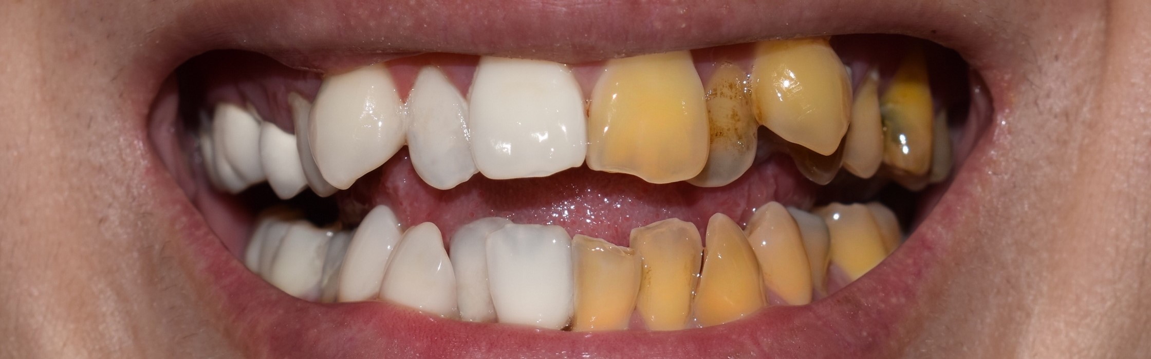 Wie eine Zahnverfärbung entsteht und wie sie behandelt wird