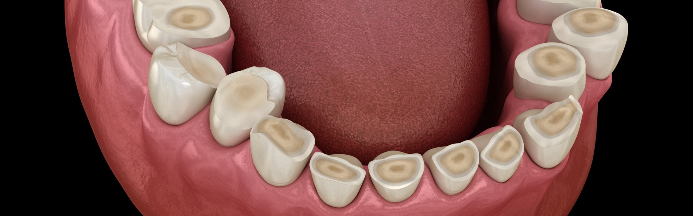 Bruxismus: Folgen von nächtlichem Zähneknirschen
