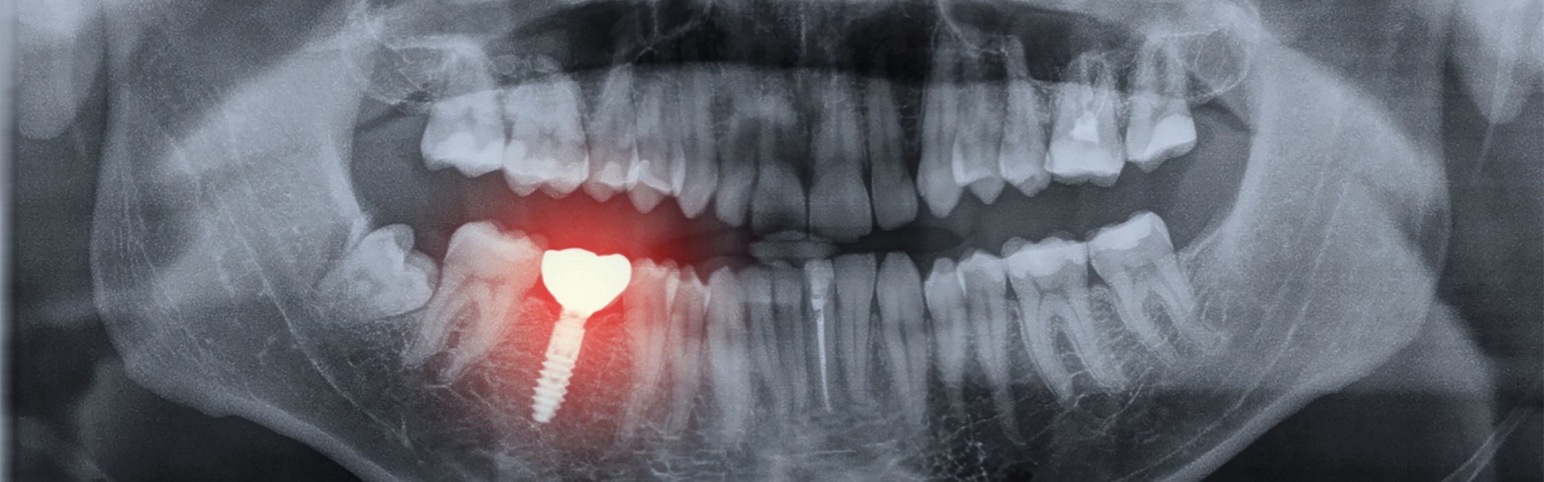 Periimplantitis: Entzündungen am Zahnimplantat erkennen und behandeln