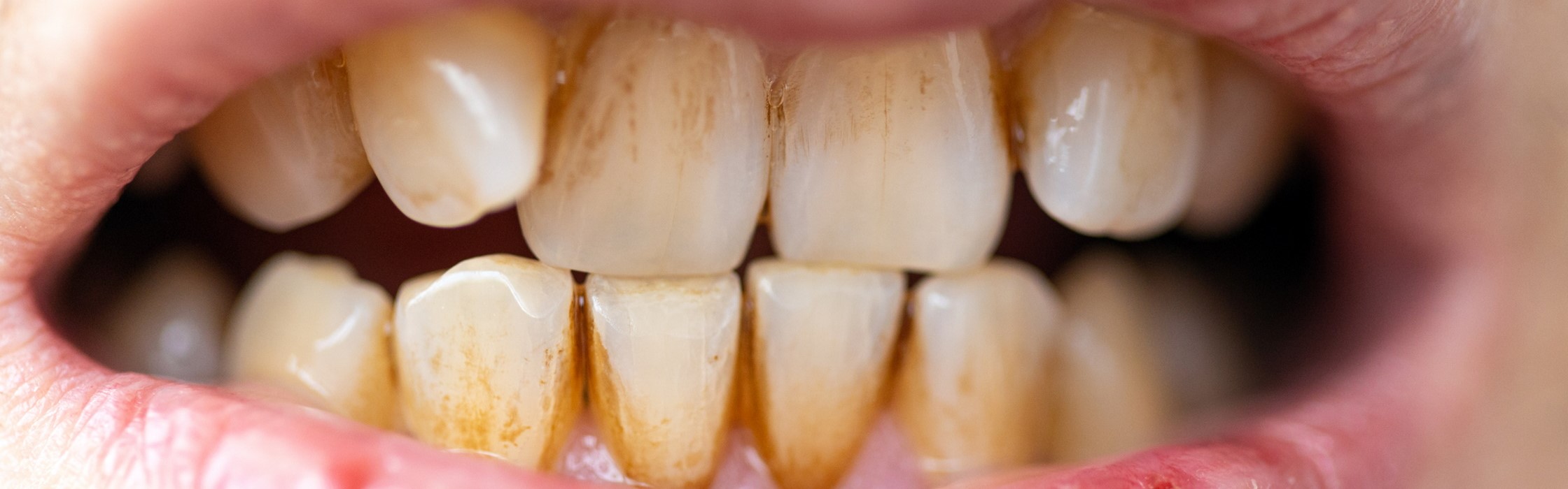 Plaque – so entfernen Sie den Biofilm auf Ihren Zähnen richtig