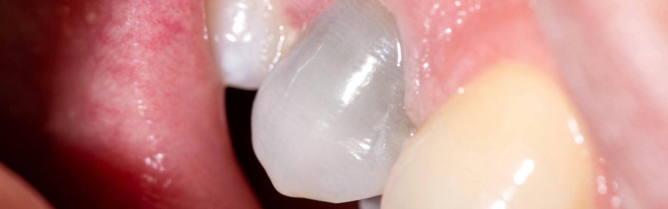 Toter Zahn: Symptome und Behandlungsmöglichkeiten