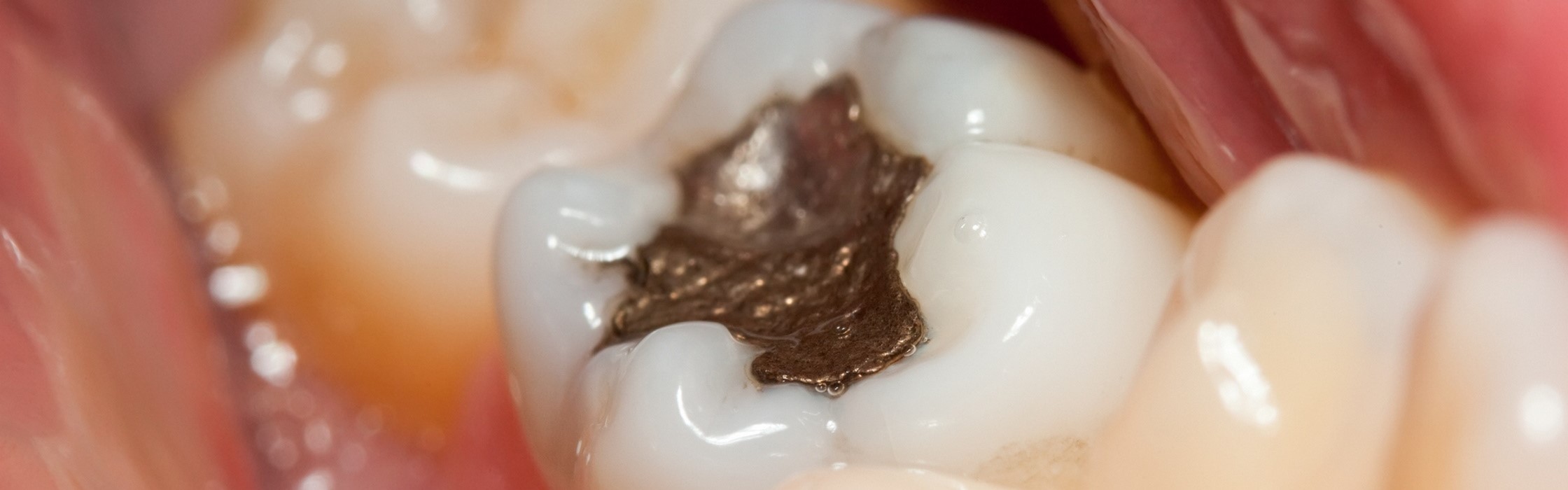 Zahnfüllungen aus Amalgam – gesundheitliches Risiko oder unbedenklich?