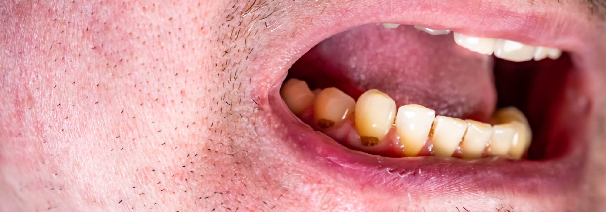 Zahnhalskaries – Ursachen und Behandlung