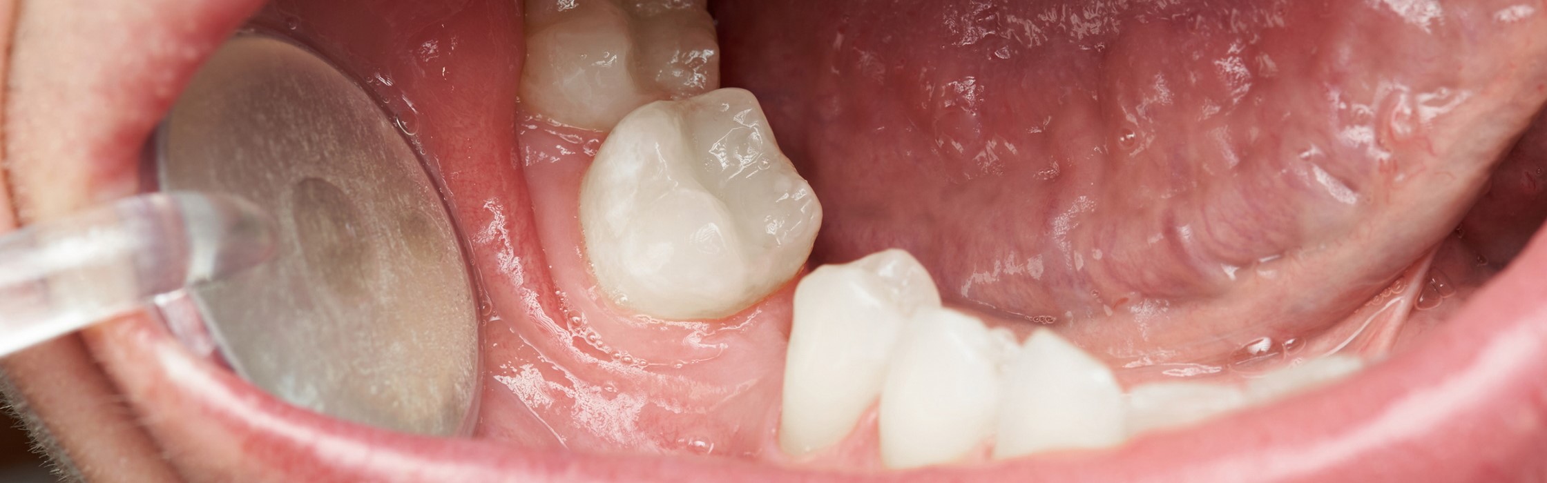 Hypodontie: Wenn Zähne im Kiefer erblich bedingt fehlen
