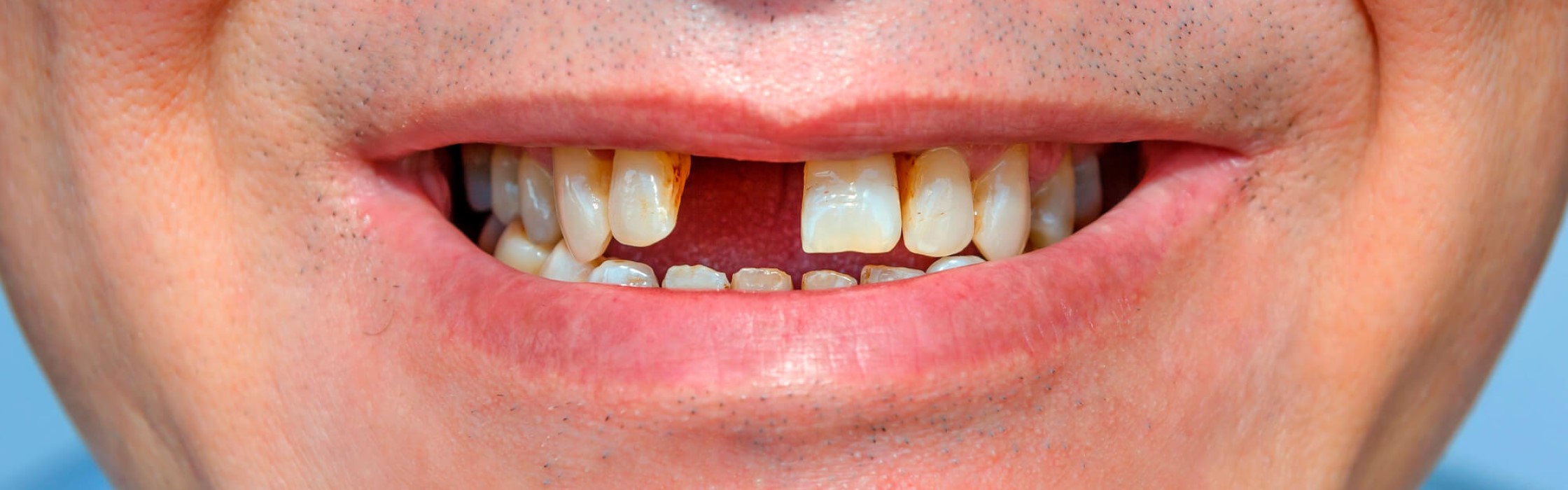 Zahnlücke: Diastema und andere Ursachen