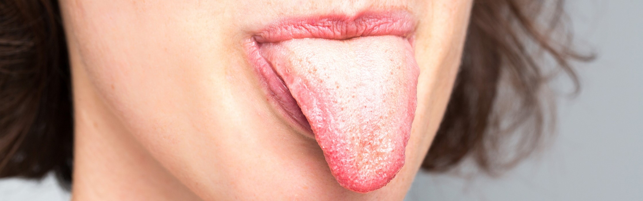 Zungenbelag: Ist eine belegte Zunge schädlich?