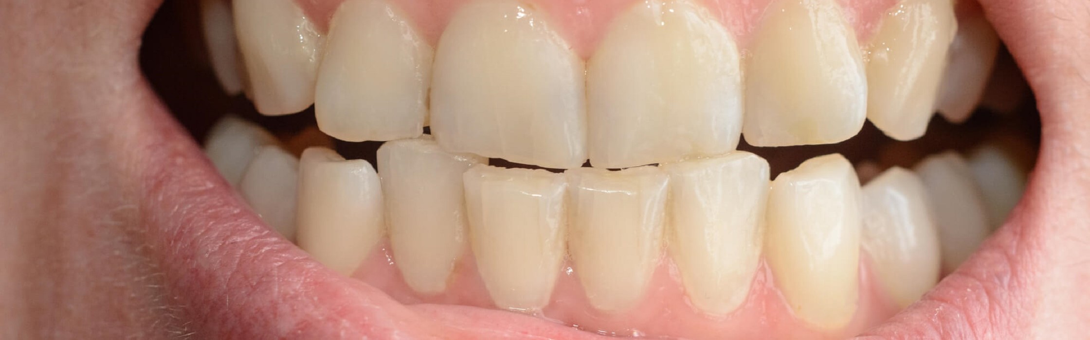 Approximale Zahnschmelzreduktion – Stripping schafft mehr Platz bei Engständen in der Zahnreihe