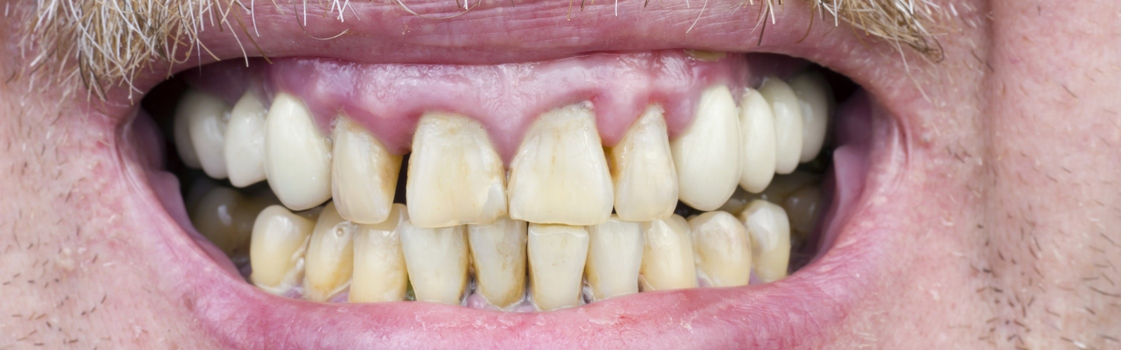 Freiliegende Zahnhälse: Symptome, Ursachen und Behandlung