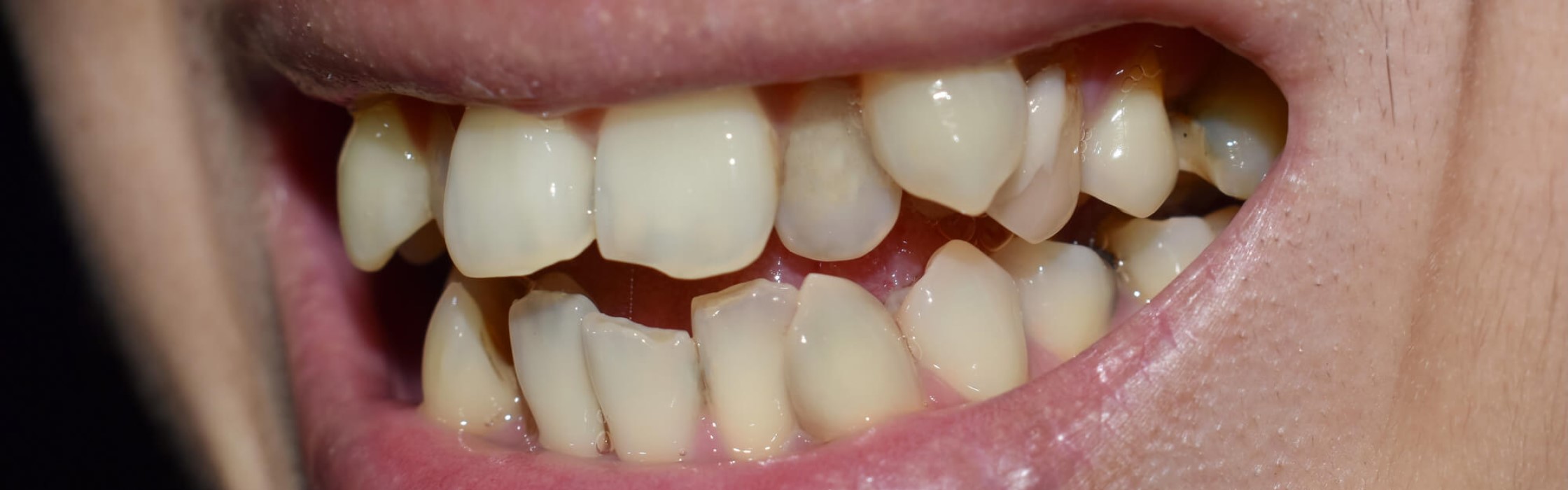 Hyperdontie: Mehr Zähne im Gebiss als vorgesehen