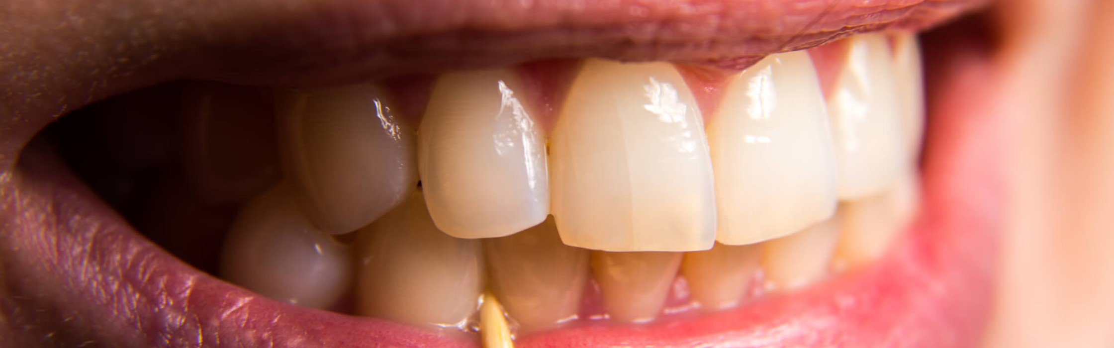 Riss im Zahn: Diese Behandlungsmöglichkeiten gibt es