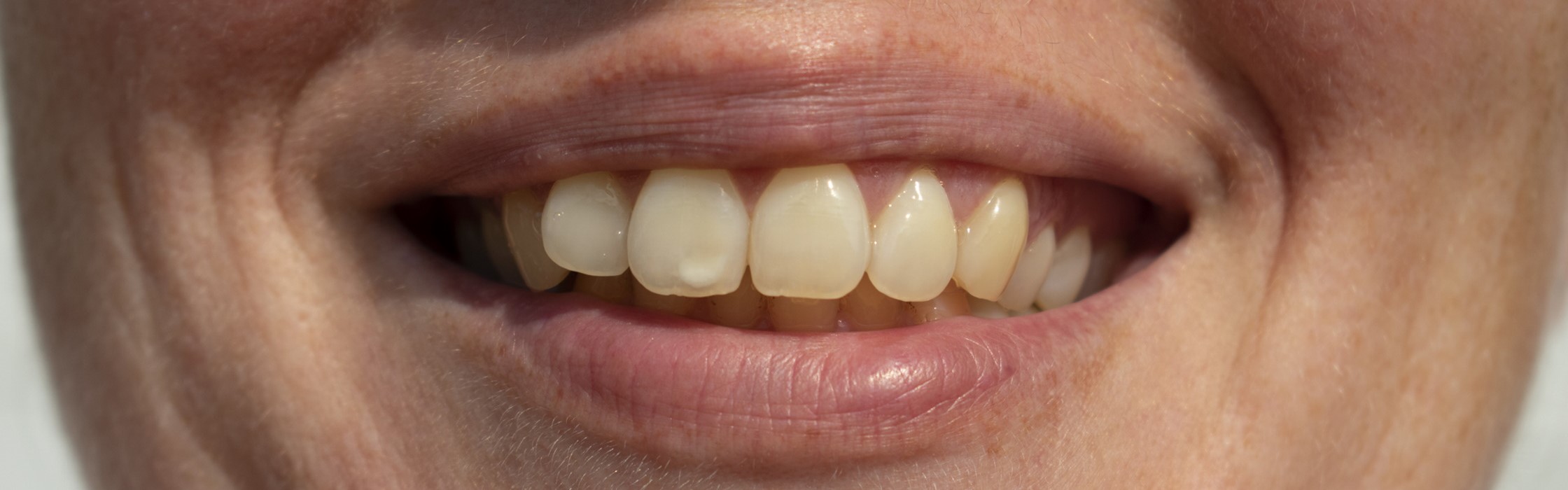 Weiße Flecken auf den Zähnen: Das sind die Ursachen