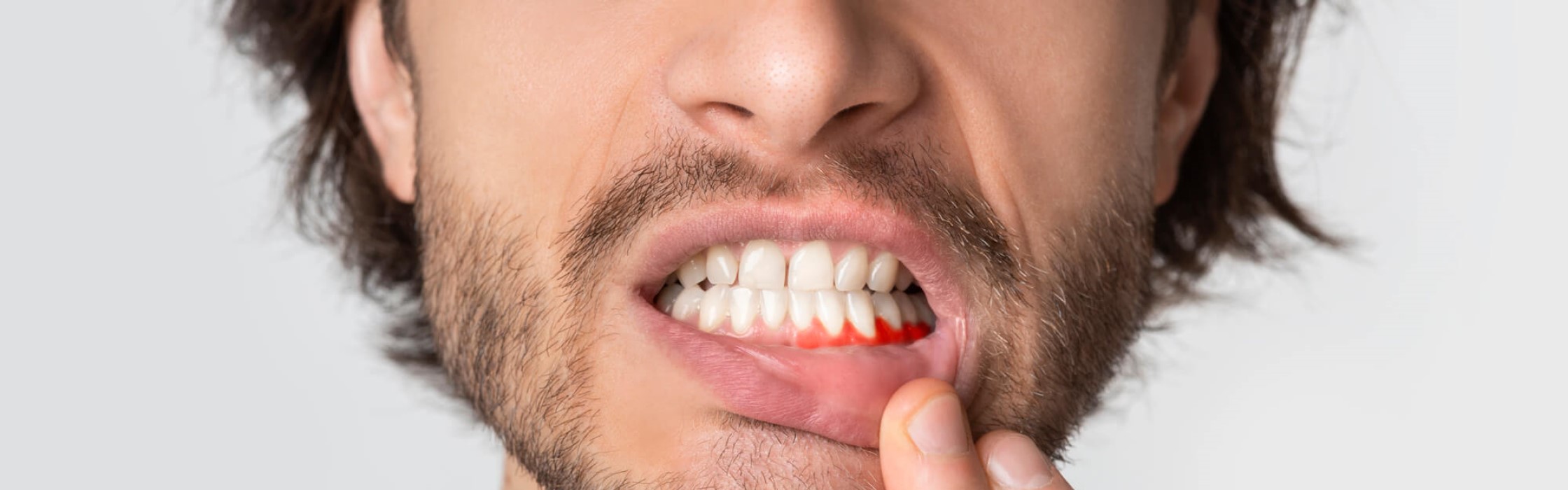 Zahnfleischrückgang: Ursachen, Symptome und Behandlung bei Zahnfleischschwund