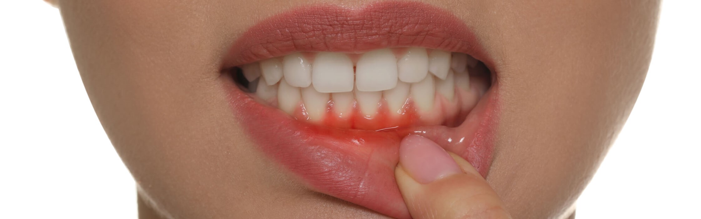 Zahnfleischtaschen: Anzeichen für Parodontitis
