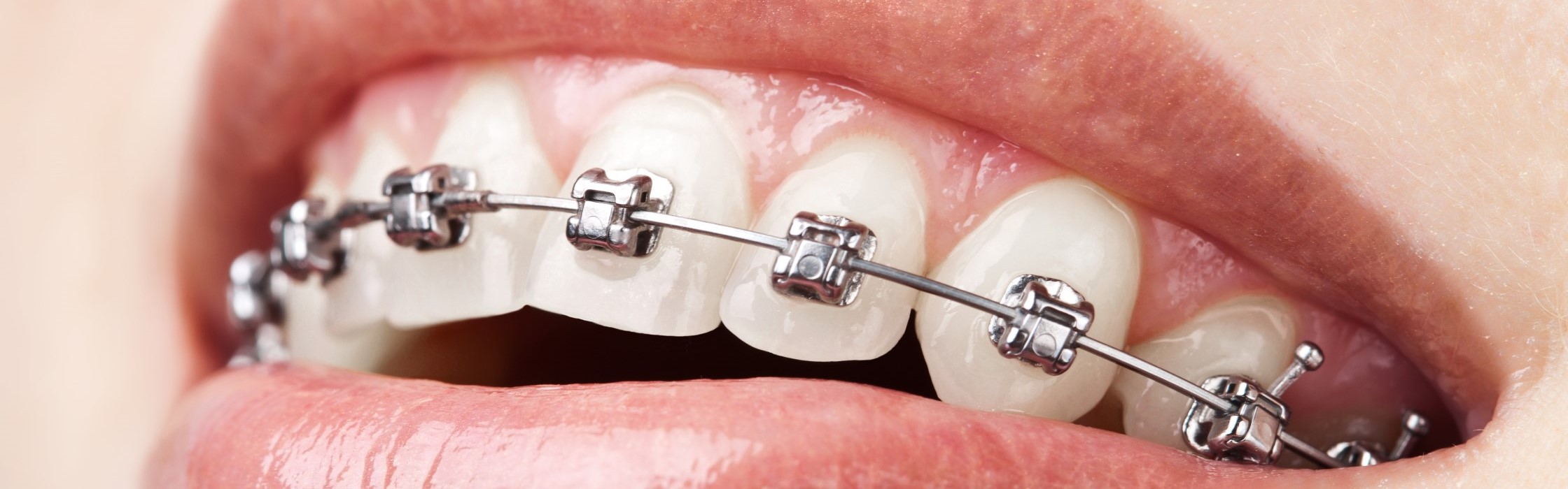 Zahnspange für Erwachsene: Das müssen Sie zur Zahnkorrektur wissen