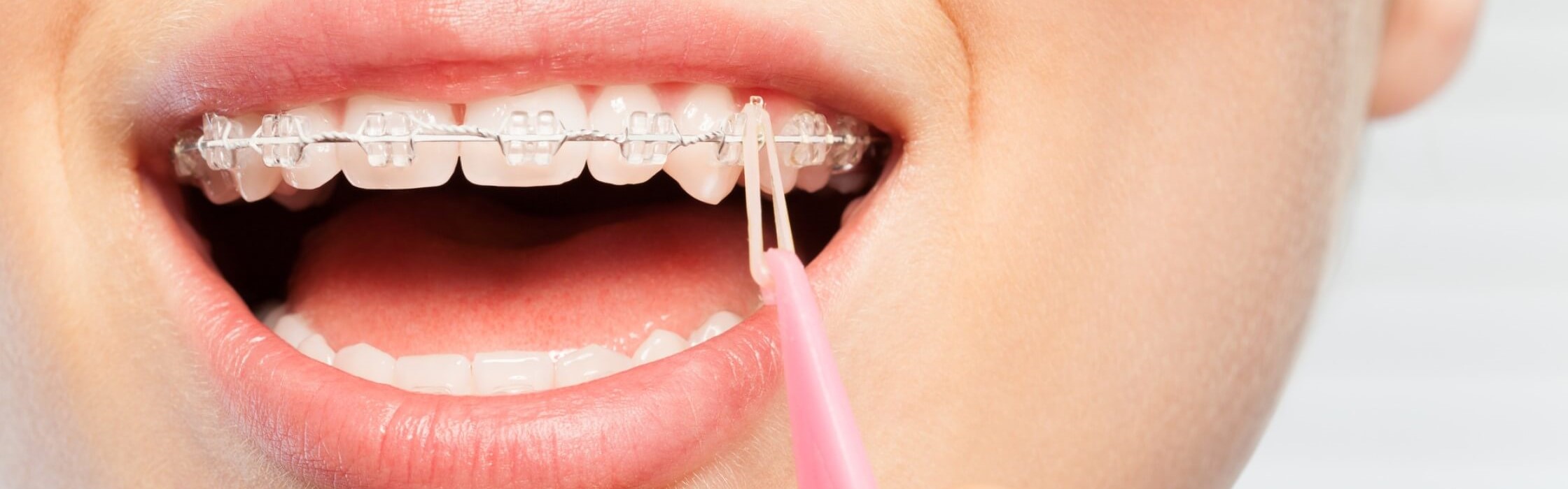 Zahnspangengummis: Anwendung, Tragedauer und Wirkung bei einer festen Zahnspange
