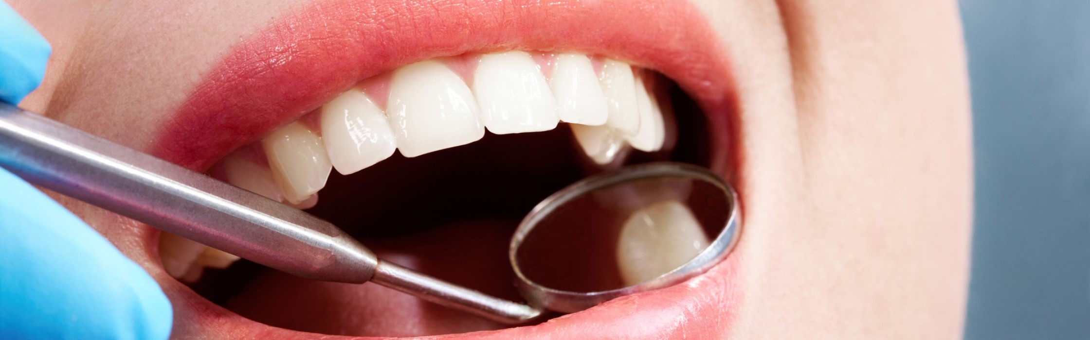 Kariesbehandlung: von Karies befallene Zähne retten