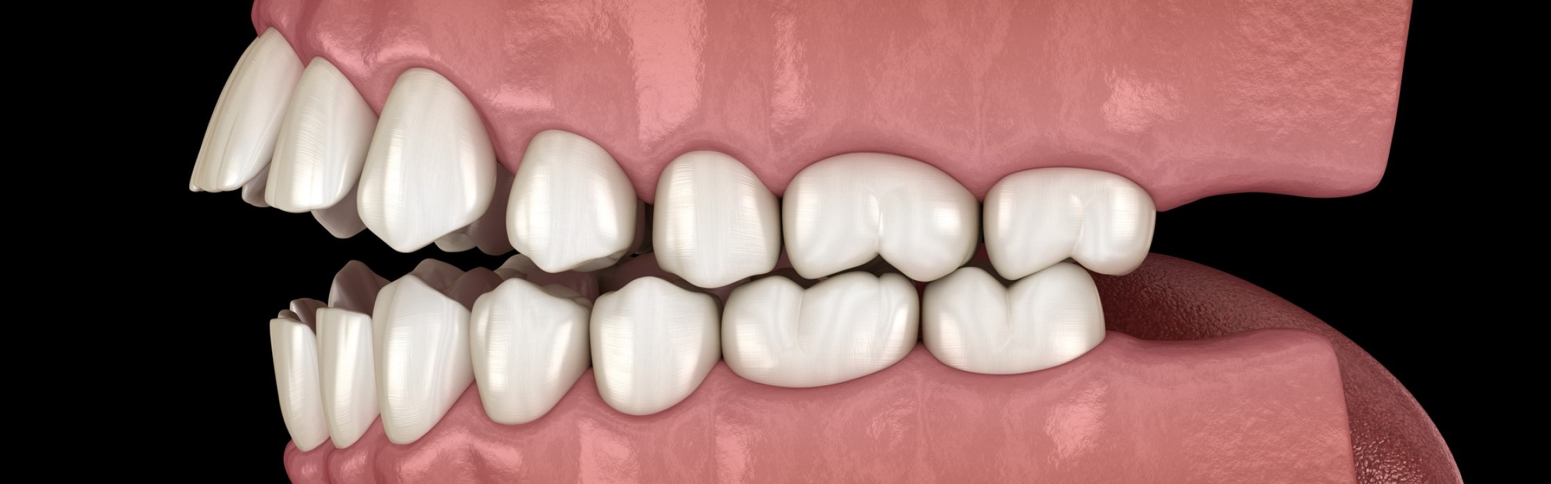 Offener Biss: Fehlstellung von Zähnen und Kiefer