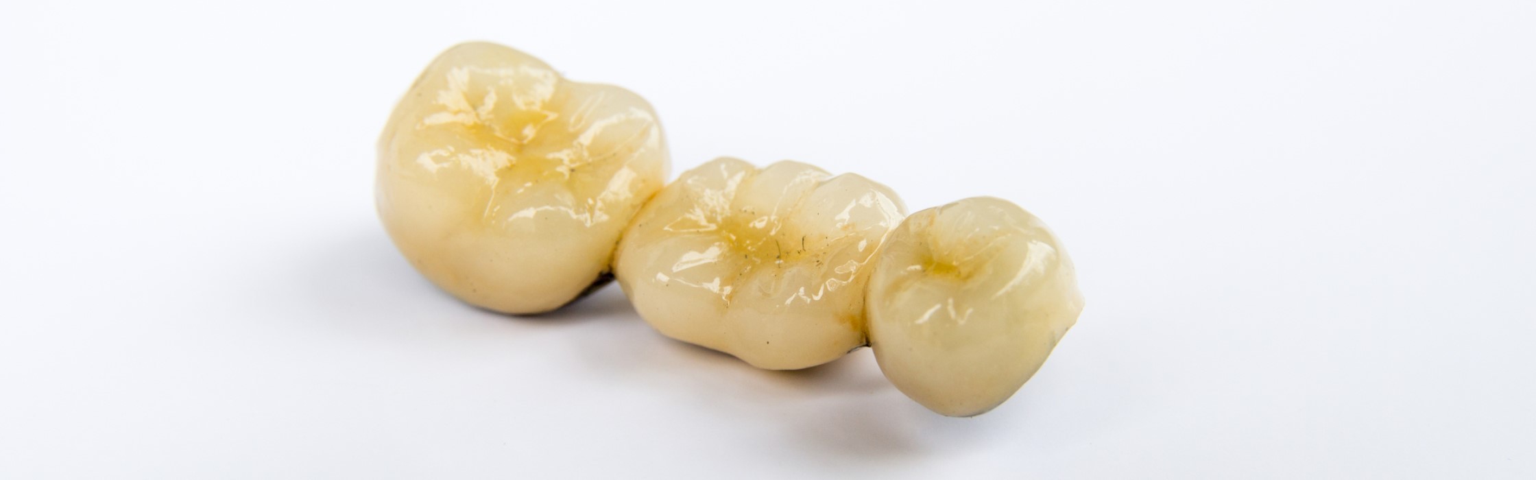 Provisorium für die Zähne: vorübergehender Zahnersatz