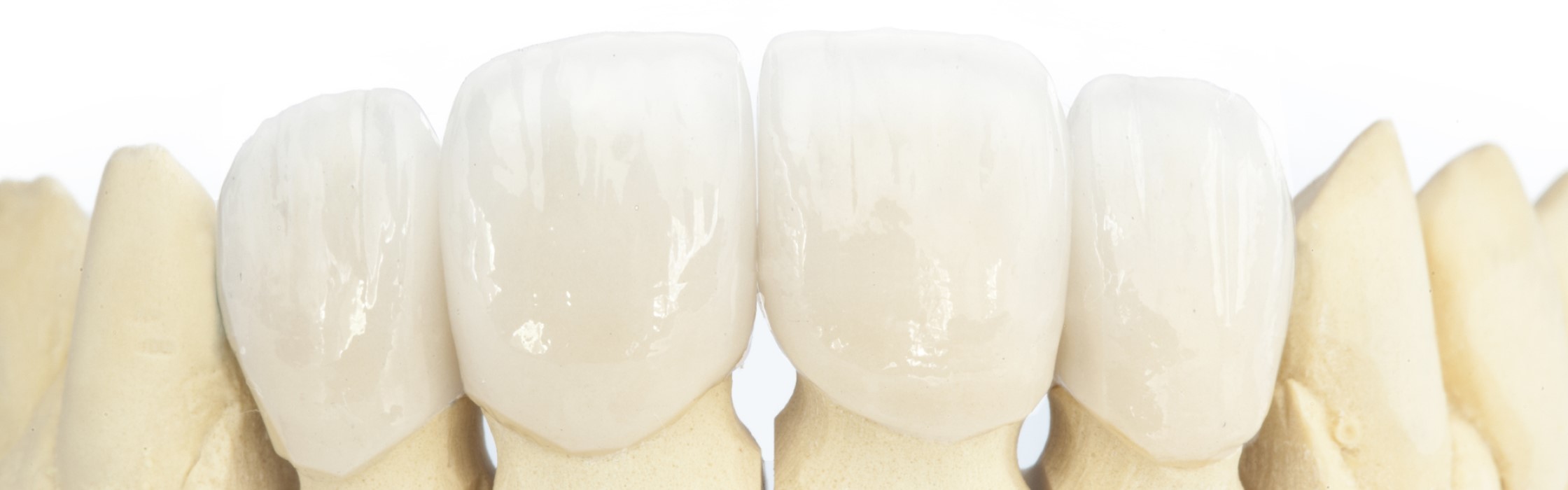SDS-Keramikimplantate: Die Zukunft der Zahnmedizin für ein strahlendes Lächeln