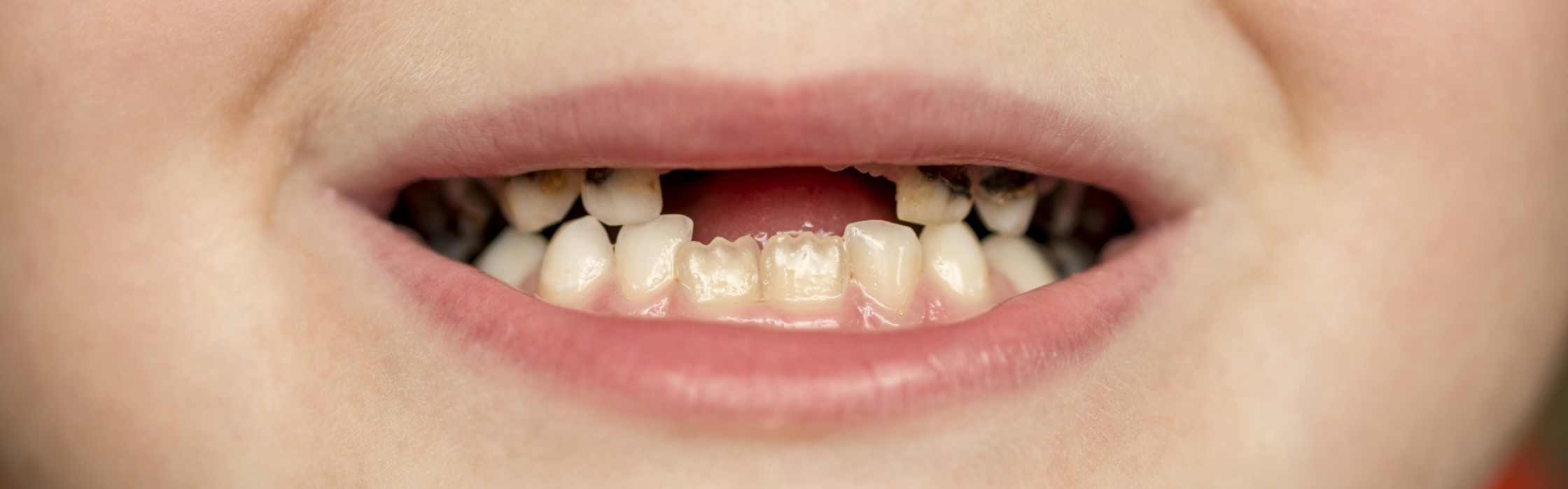 Faule Zähne: Was tun bei Kariesbefall der Zähne?