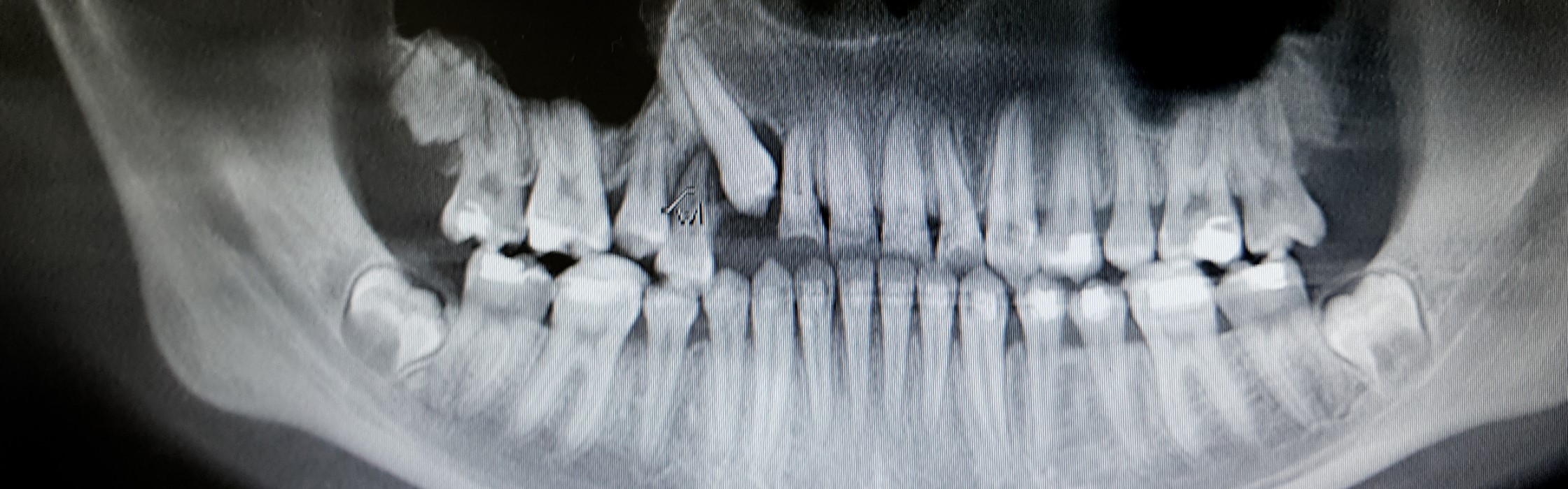 Retinierter Zahn: Ursachen und Behandlung der Fehlstellung