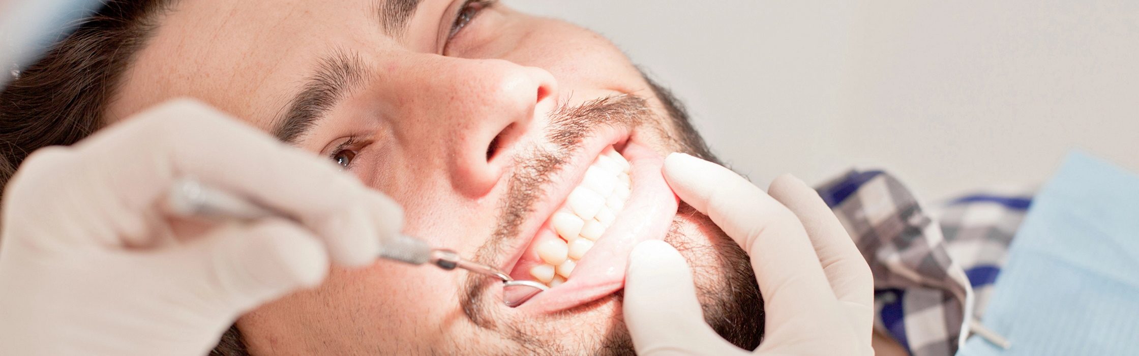 Sekundärkaries: Karies unter einer Zahnkrone oder Füllung