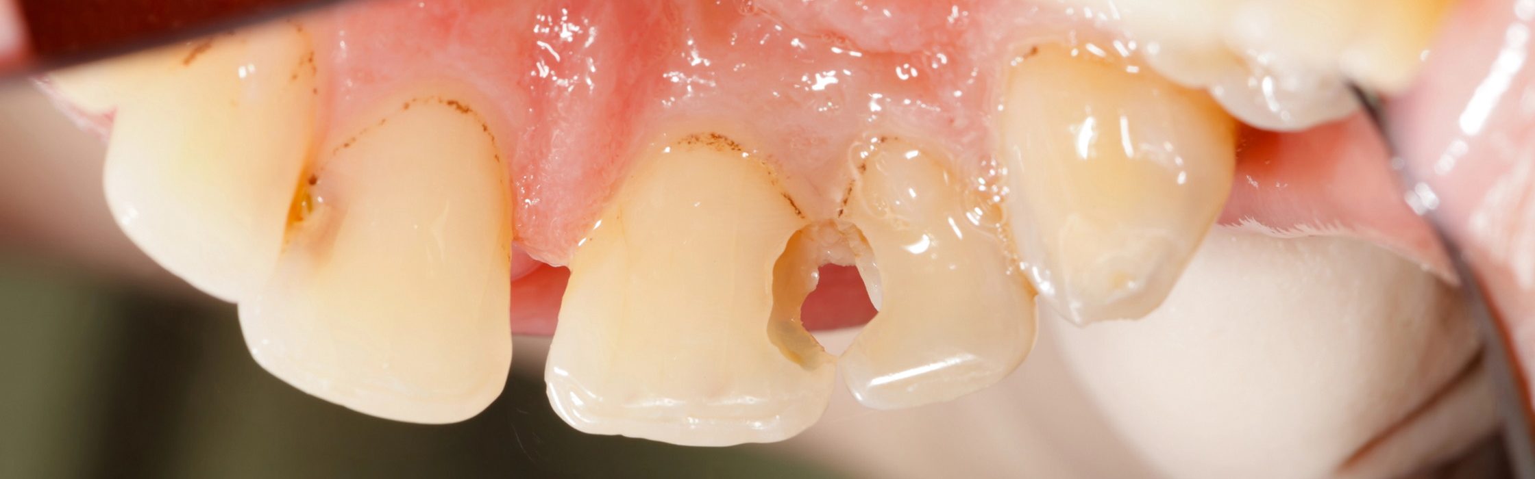 Caries profunda: tiefe Karies erkennen und behandeln