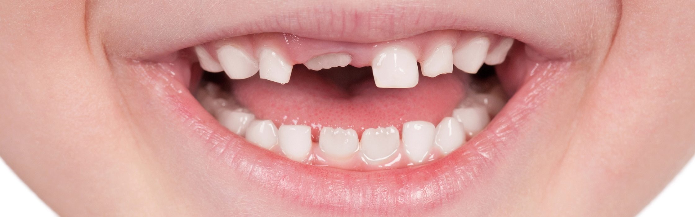 Zahn selber ziehen oder besser zum Zahnarzt gehen?